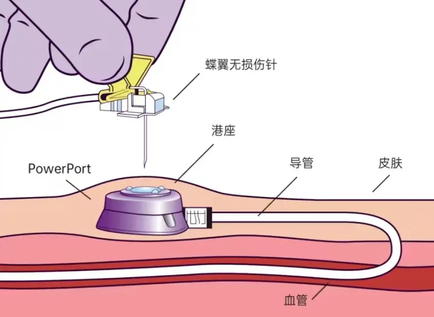 健康科普｜静脉输液港：长期输液患者的理想选择